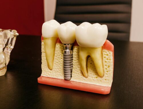 Dental Implants: A Long-Term Solution for Missing Teeth
