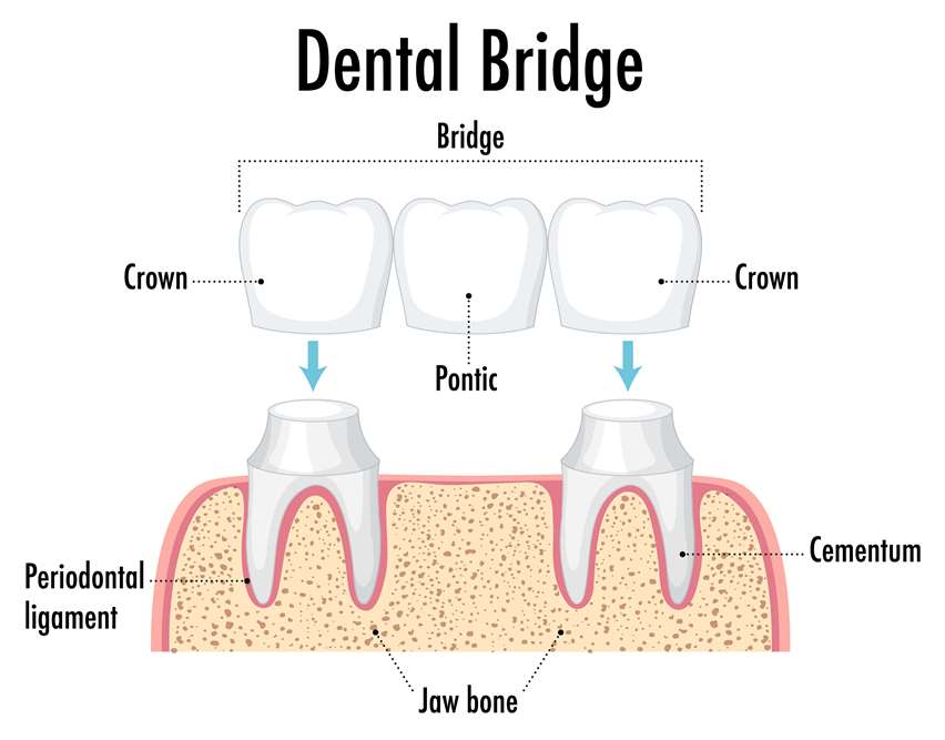 Dental Bridges_ Bridging the Gap for Missing Teeth