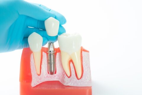 Dental implant model with gloved hand.